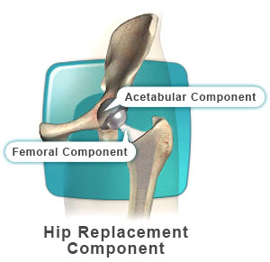 hip replacement surgery